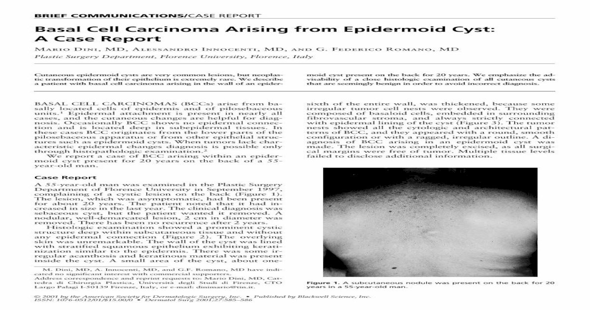Basal Cell Carcinoma Arising from Epidermoid Cyst: A Case Report - [PDF ...