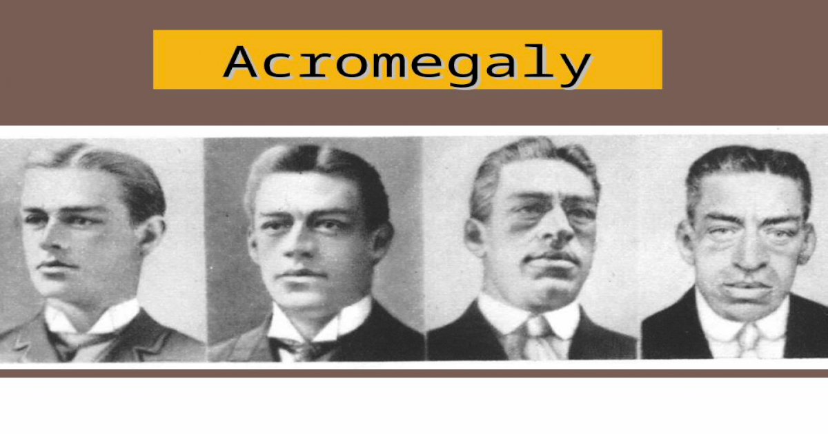 Acromegaly Acromegaly It Is A Rare Hormonal Disorder That Develops